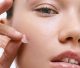 top blemish patch picks